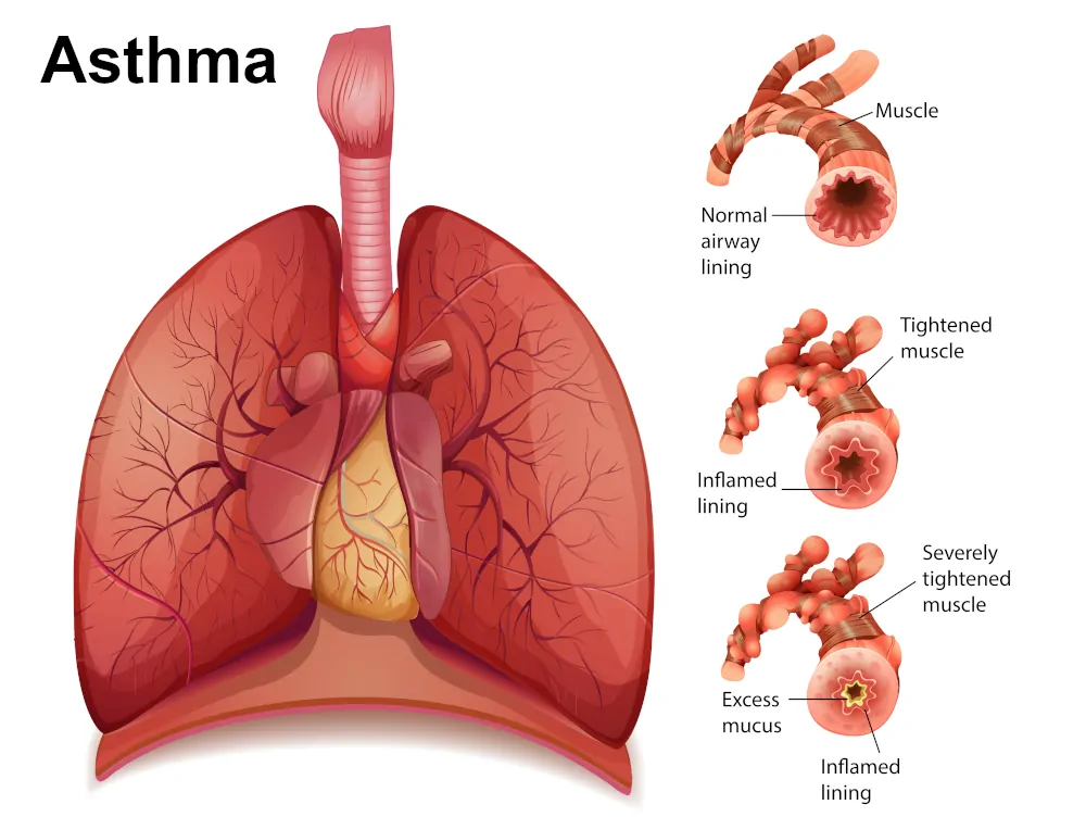 Asthma: The Ayurvedic Concept