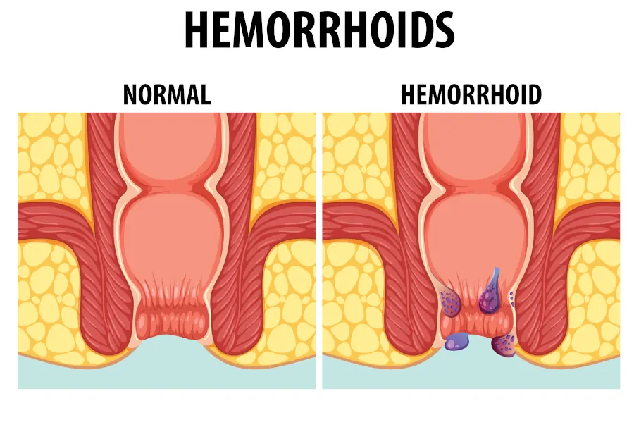 hemorrhoids