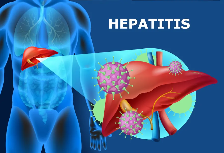 hepatitis