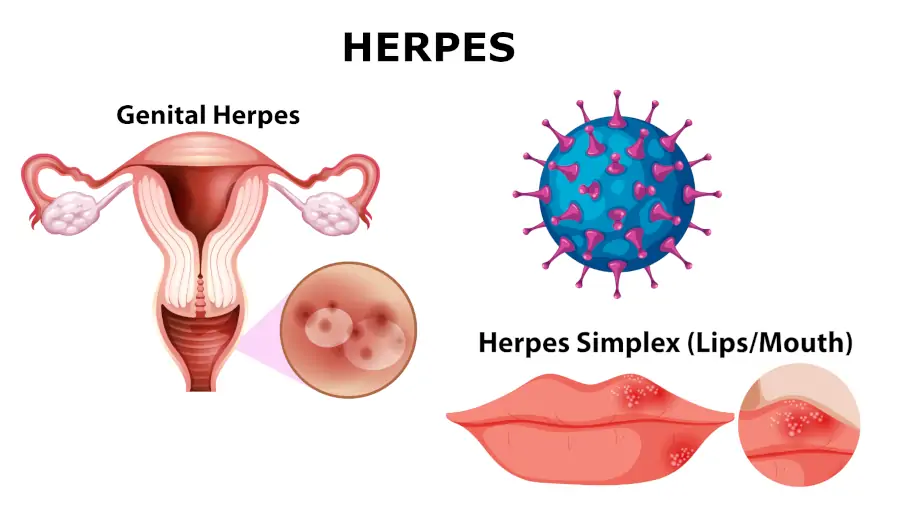 herpes