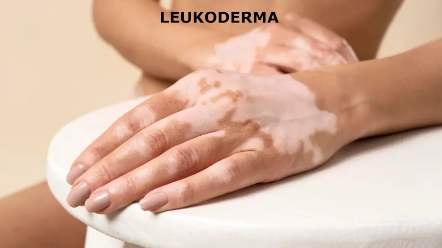 leukoderma